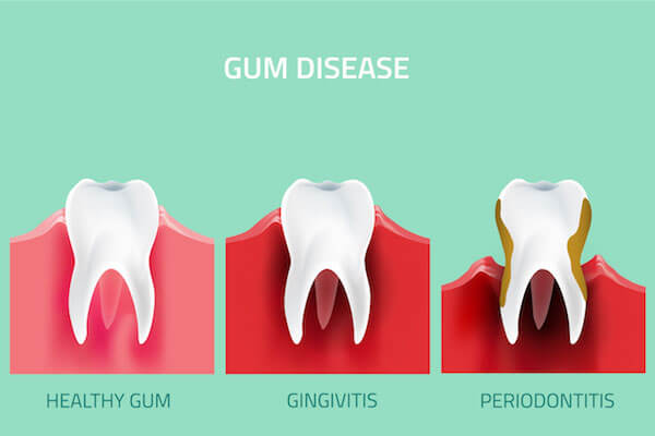 gingivitis periodontitis