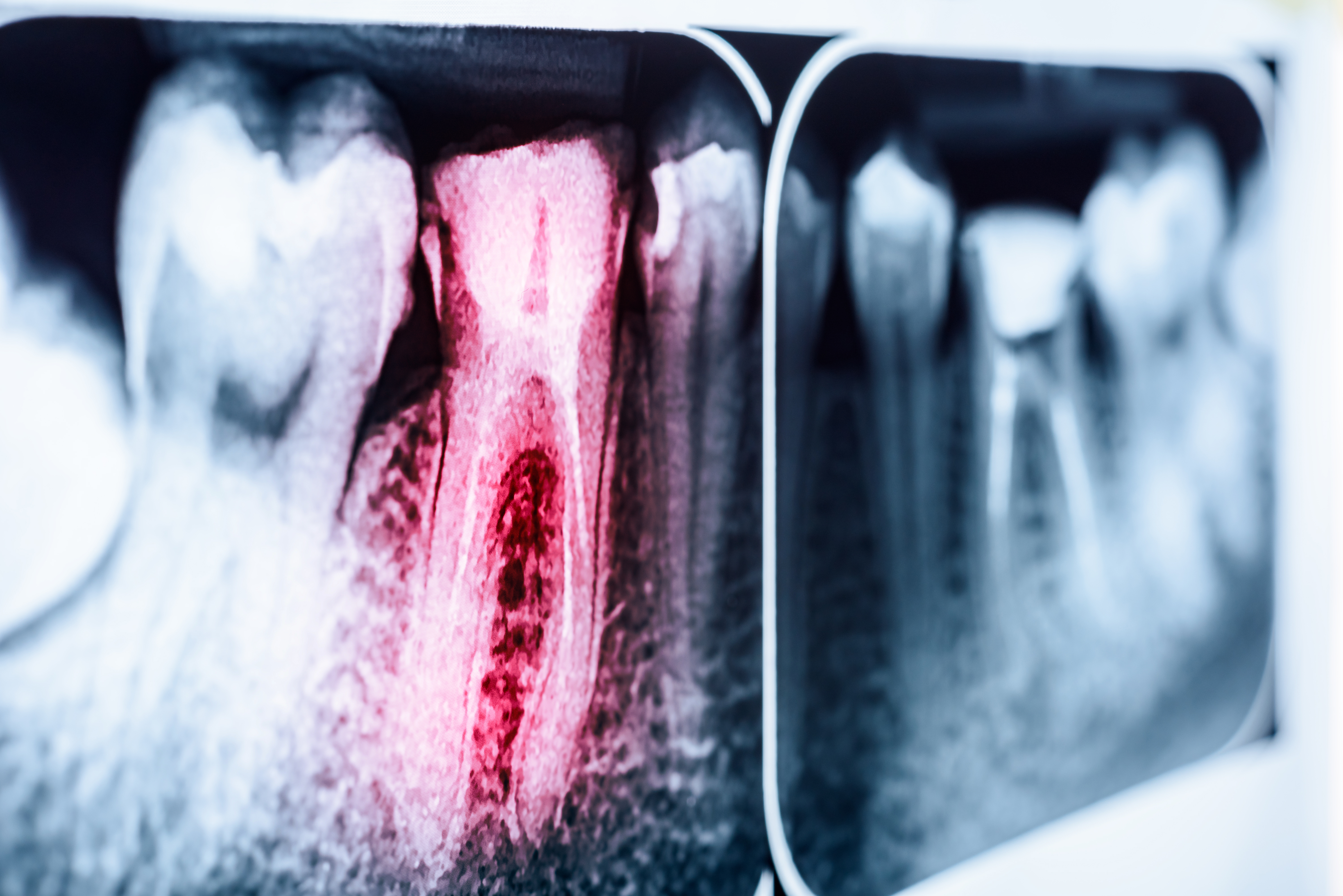 Tooth Decay